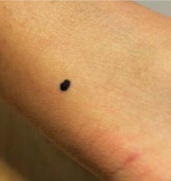 Langzaam groeiende plek