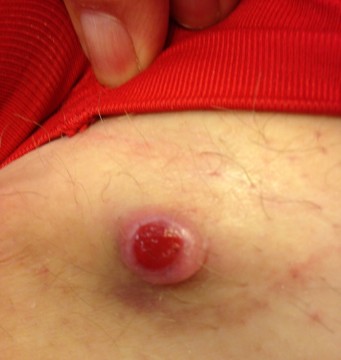 Bultje in linker lies