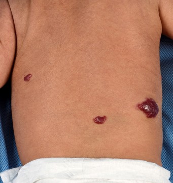 Baby met groeiende rode bulten