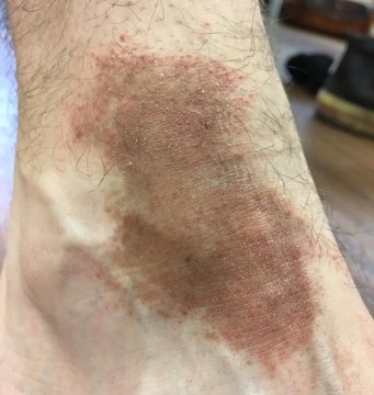 Bruin verkleurde enkel