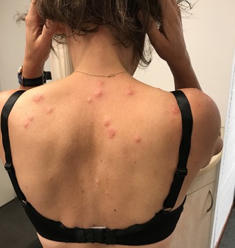 Licht branderige, rode bulten