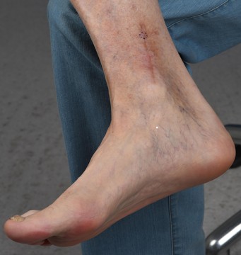 Blauw doorschemerende nodulus