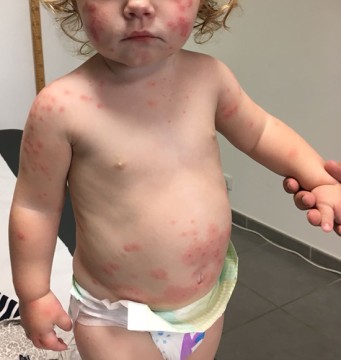 Jeukende huiduitslag