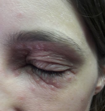 Stekende pijn aan oog