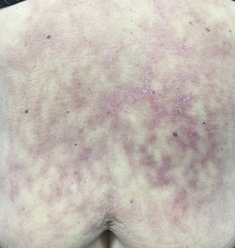 Reticulaire huidafwijkingen