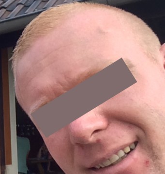 Zwelling op voorhoofd