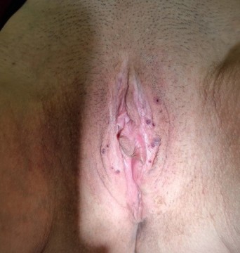 Schaamlippen met paarse spots