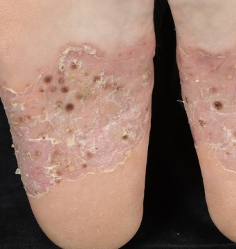 Pustels en schilfers