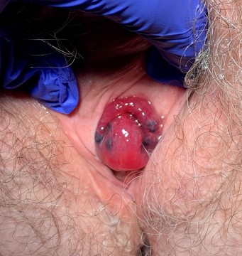 Urogenitale zwelling