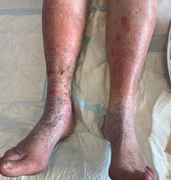 Wel of geen erysipelas