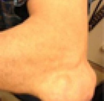 Poll afwijking aan ellebogen