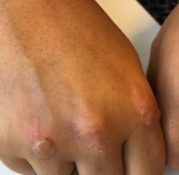 Poll blaren op handen