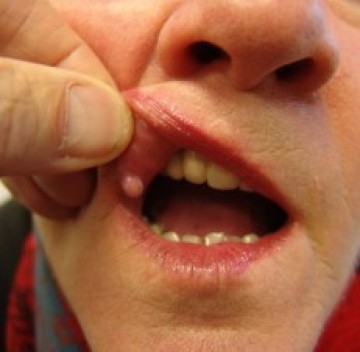 Poll Bobbeltje op lip