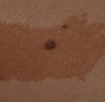 Poll café-au-laitvlek