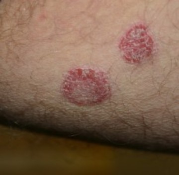 Poll symmetrische laesies 