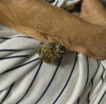 Poll gesteelde hyperkeratotische nodus