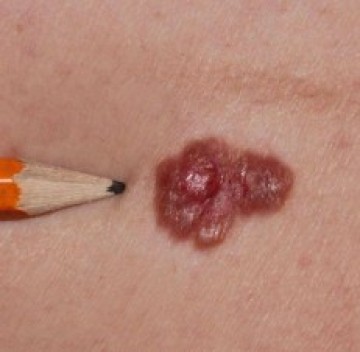 Poll Plekje rechterarm