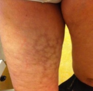 Poll plekken op benen