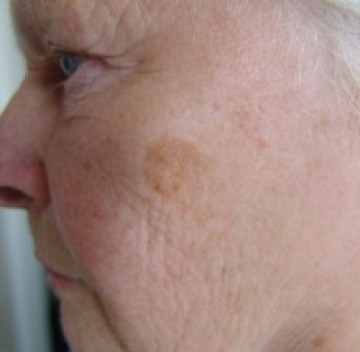 Poll plek op rechterwang