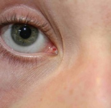 Poll Rode plek in oog