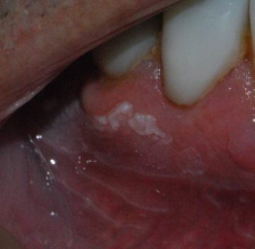 Poll witte vlek op het tandvlees