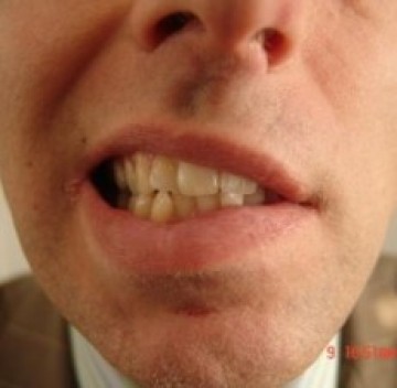 Aangezichtsverlamming