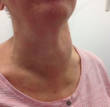 Poll zwelling in hals