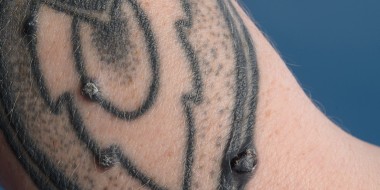 Tatoeage met bultjes