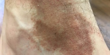 Bruin verkleurde enkel