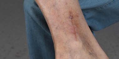 Blauw doorschemerende nodulus