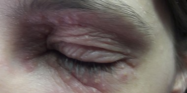 Stekende pijn aan oog