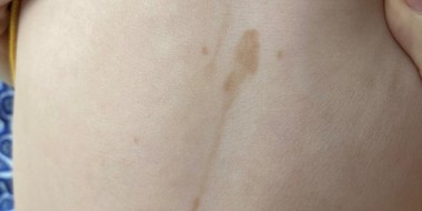 Lineaire huidafwijking