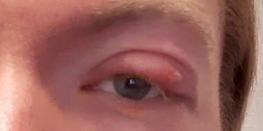 Plekje op ooglid