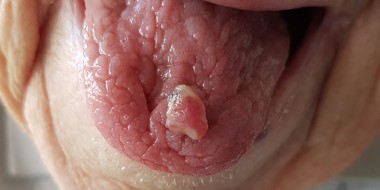 Afwijking op de tong