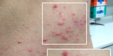 Bijzondere gordelroos