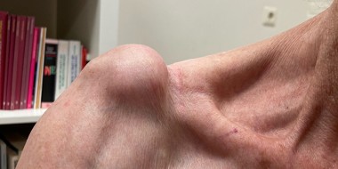 Zwelling op een schouder