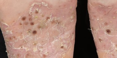 Pustels en schilfers