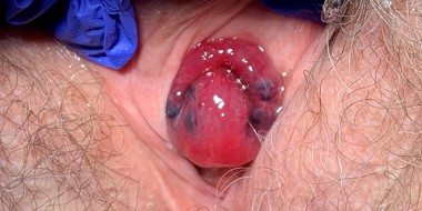 Urogenitale zwelling