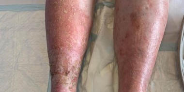 Wel of geen erysipelas