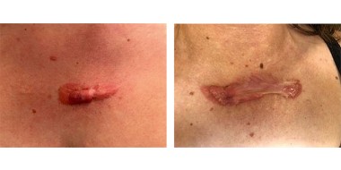 Beperkt (links) en uitgebreid (rechts) keloïd