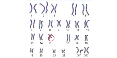 Bij PWS komt een essentieel stukje genetisch materiaal op chromosoom nummer 15 dat van de vader afkomstig is, niet tot uiting