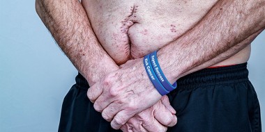 Mannenbuik met groot litteken van de navel naar de schaamstreek