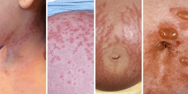 Huidafwijkingen zwangerschap