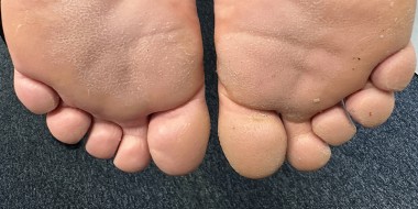 Pitted keratolysis onder beide voeten