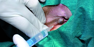 Lokaal verdoven bij getromboseerde anale randvene