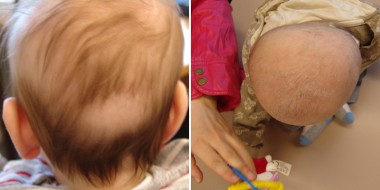 Schedelvervorming (plagiocefalie)