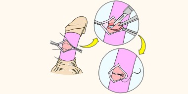 Operatie bij Peyronie