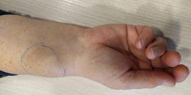 Zwelling pols 2