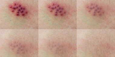 herpes zoster-infectie