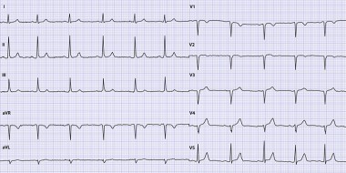 Ecg-cas Schouderpijn